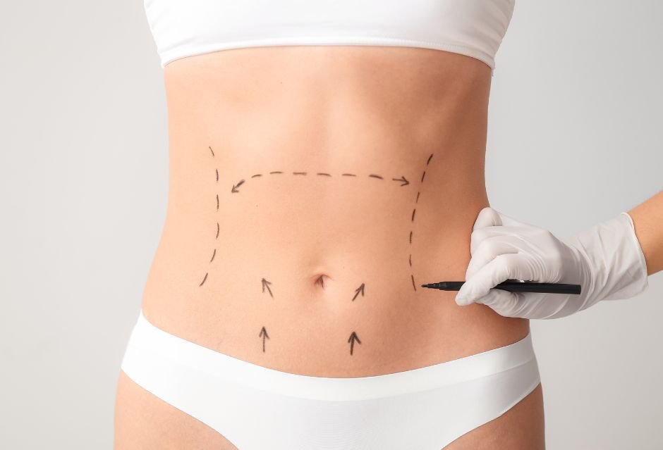 Abdominoplasty treatment