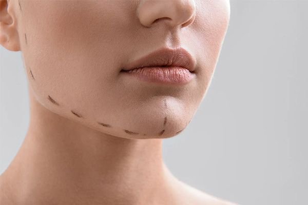 Chin Implant treatment