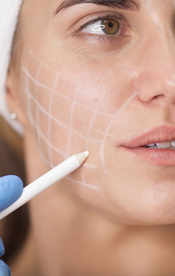 Facelift treatment