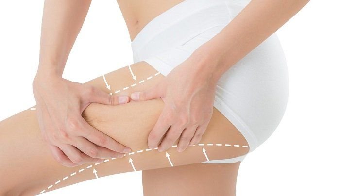 Thigh Lift treatment