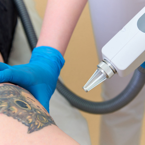 10- Laser Tattoo Removal