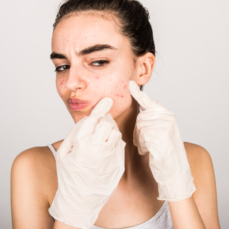 11- Acne Scar Reduction